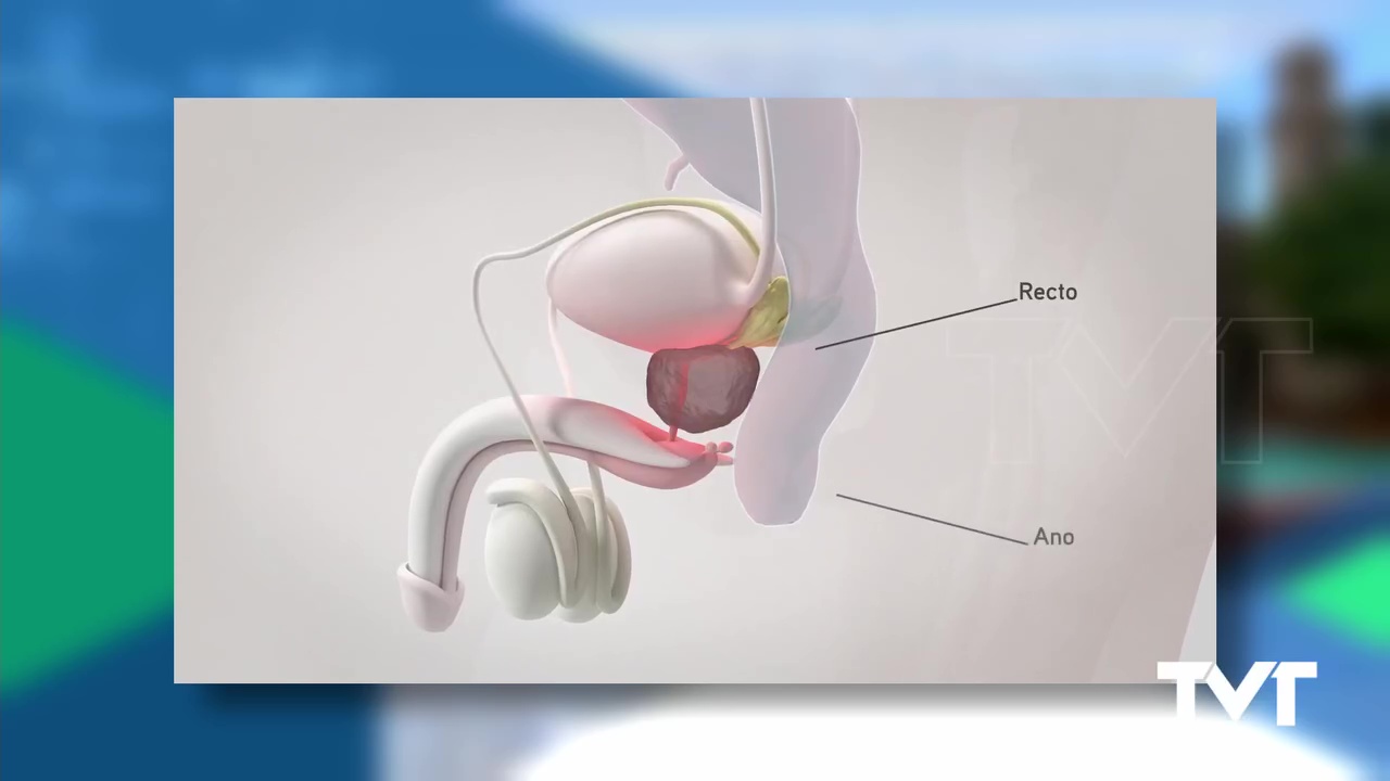 Imagen de Más del 80% de los casos de cáncer de próstata se diagnostican en estadios tempranos